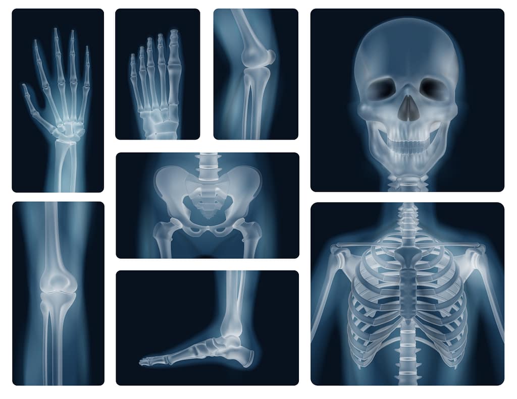 X-ray images of human bones, showing detailed skeletal structures. The illustration highlights various bone scans that are important to diagnose Osteoradionecrosis so that patients can receive Hyperbaric Oxygen Therapy for Osteoradionecrosis